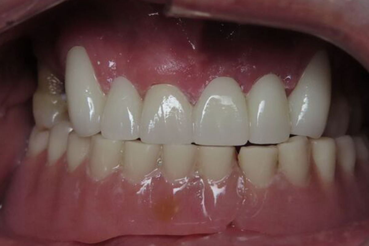 patient after implants