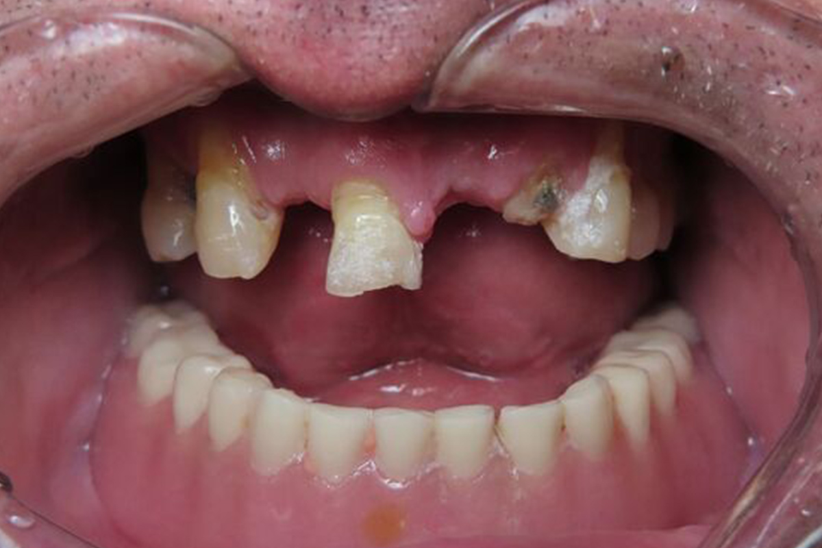 patient before implants