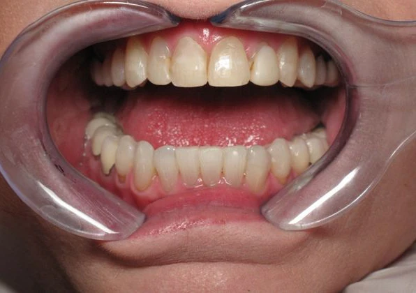 smile before veneers