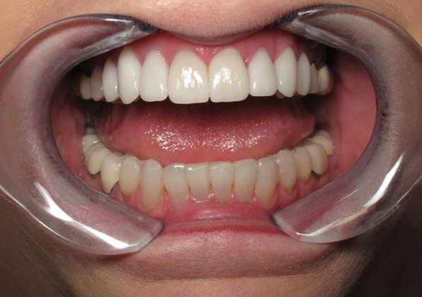 Pendergrass and Wilkie patient after veneers