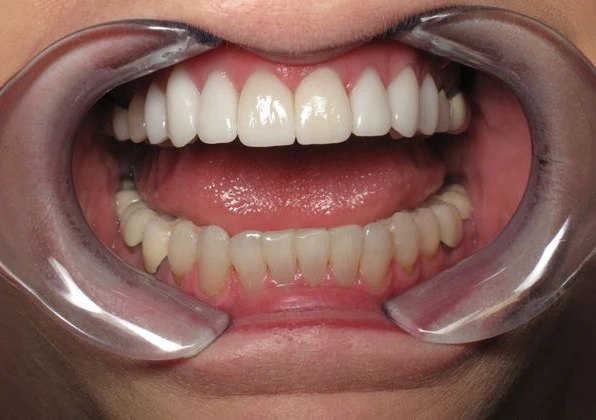 smile after veneers