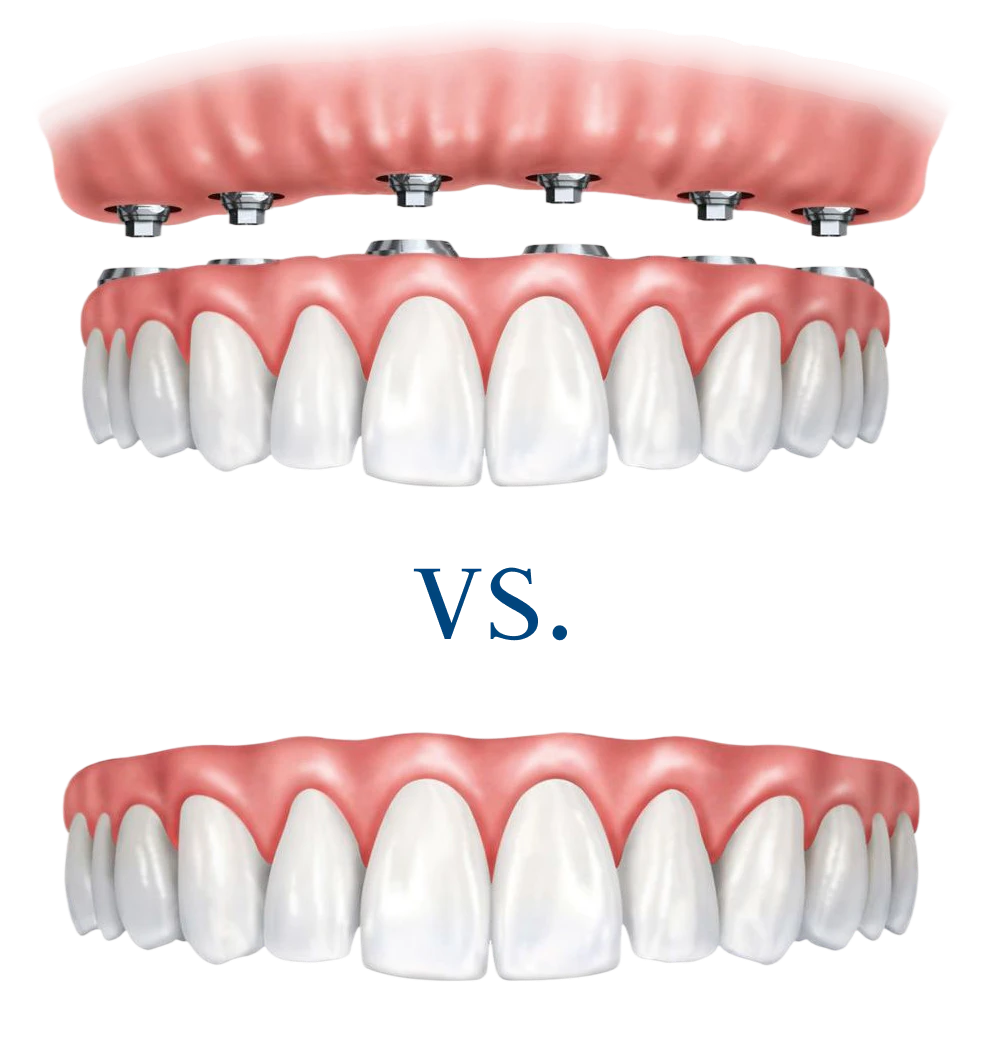 3D illustration comparing implant-supported dentures with titanium posts to a traditional full denture