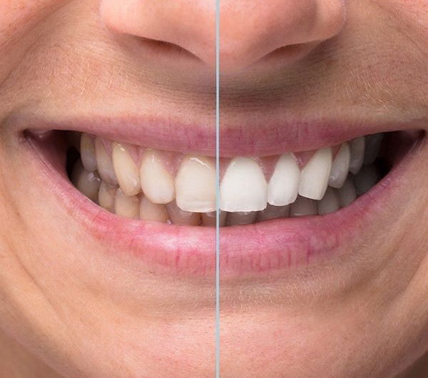 before and after whitening