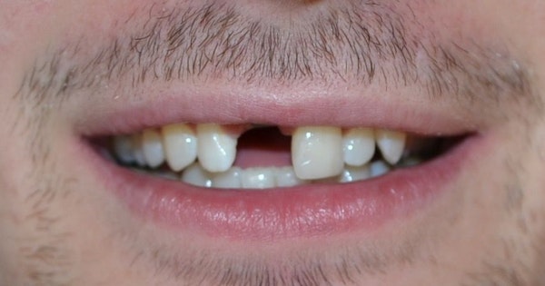 smile with missing tooth