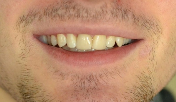 smile restored with dental implant