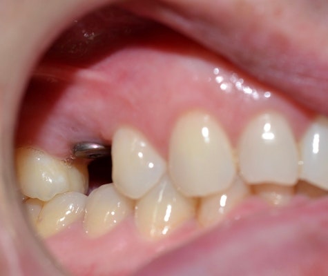 smile with a missing tooth