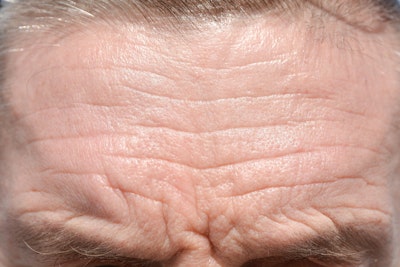 Forehead lines