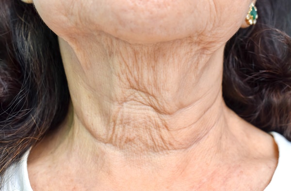 Loose and wrinkled skin around the neck and chin