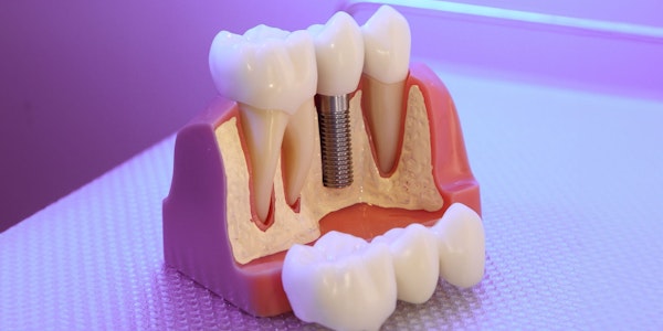 dental implant model