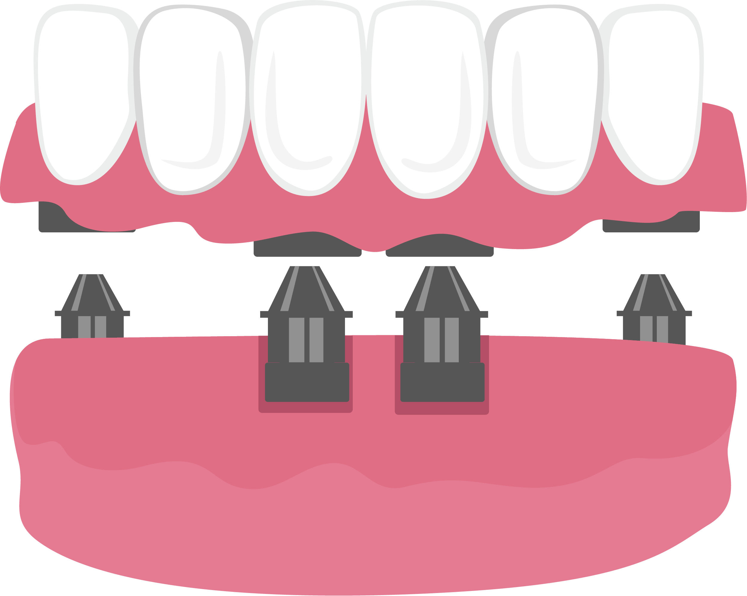 full denture