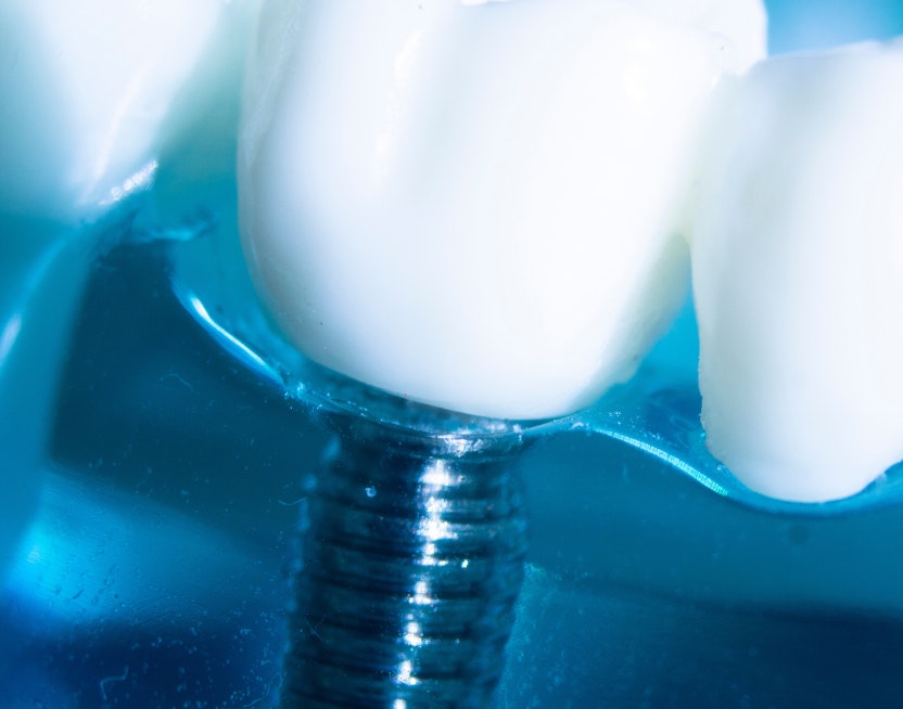 dental implant model