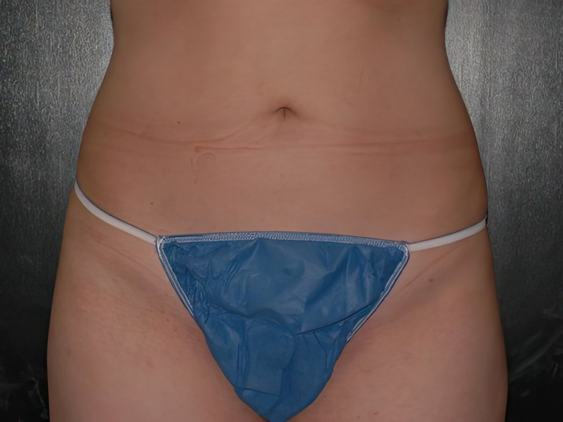 After liposuction procedure
