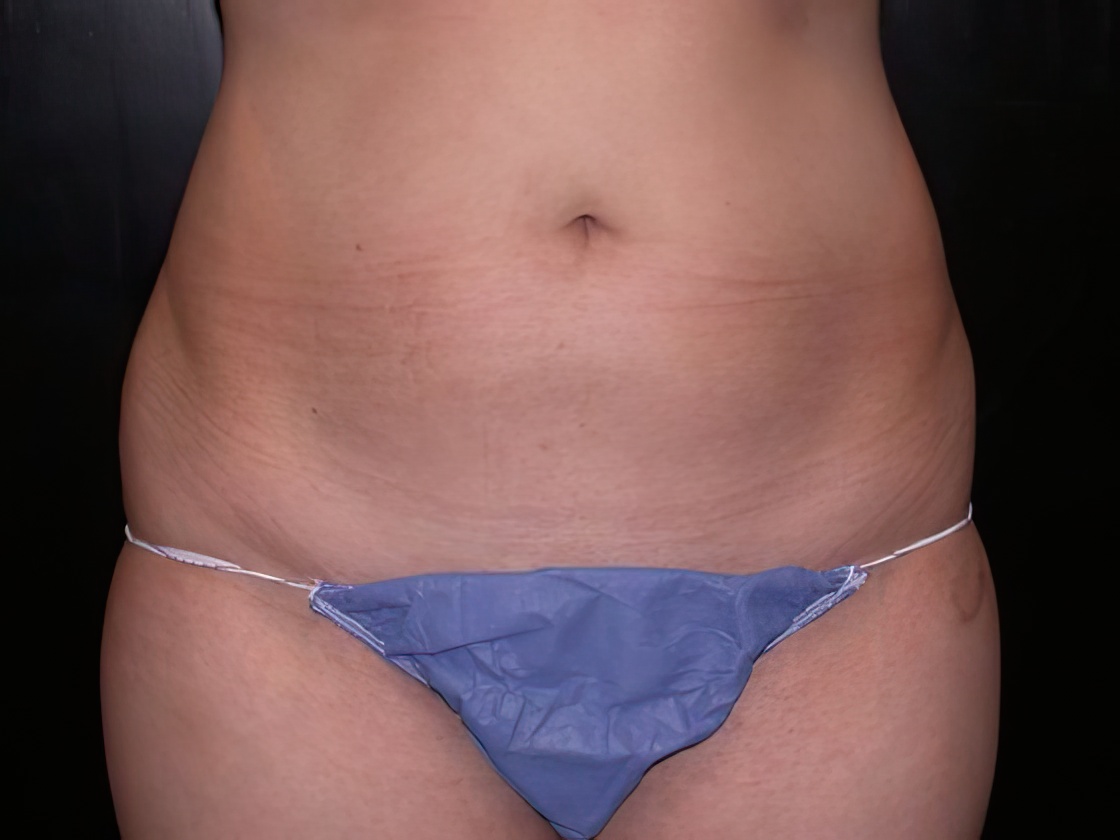 Before liposuction procedure