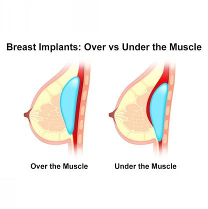 Diagram comparing breast implant placements over and under the muscle