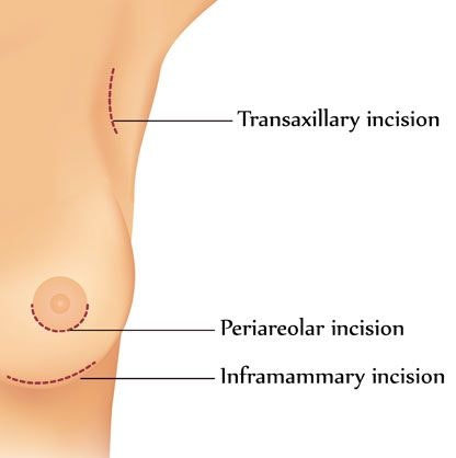 Periareolar, inframammary, and axillary incisions illustration