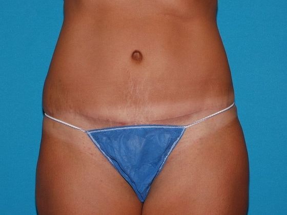 Carmel Cosmetic and Plastic Surgeons patient after tummy tuck procedure