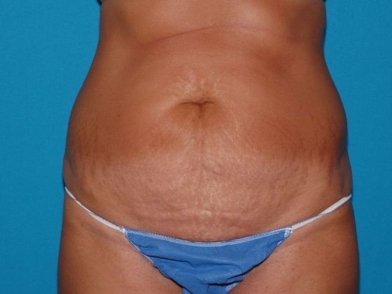 Carmel Cosmetic and Plastic Surgeons patient before tummy tuck procedure