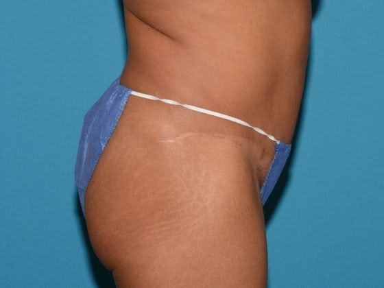 Carmel Cosmetic and Plastic Surgeons patient after abdominoplasty procedure