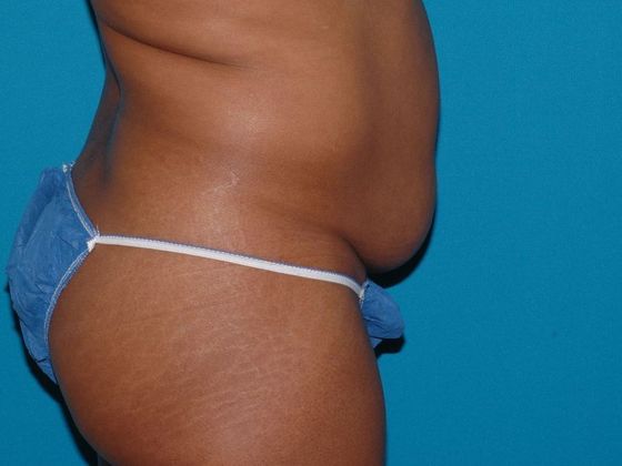 Carmel Cosmetic and Plastic Surgeons patient before abdominoplasty procedure