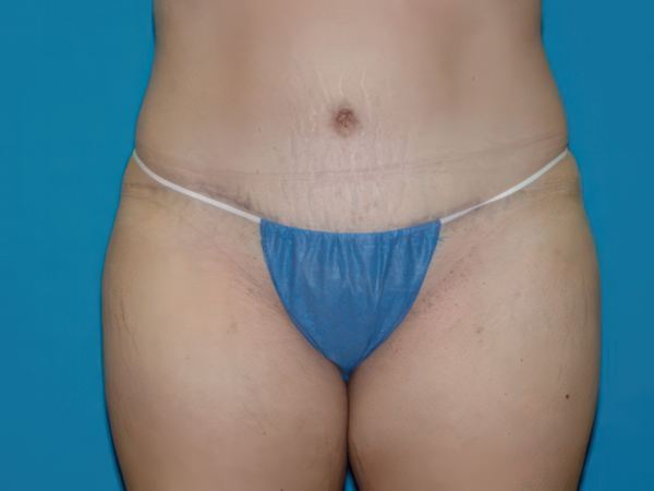after tummy tuck