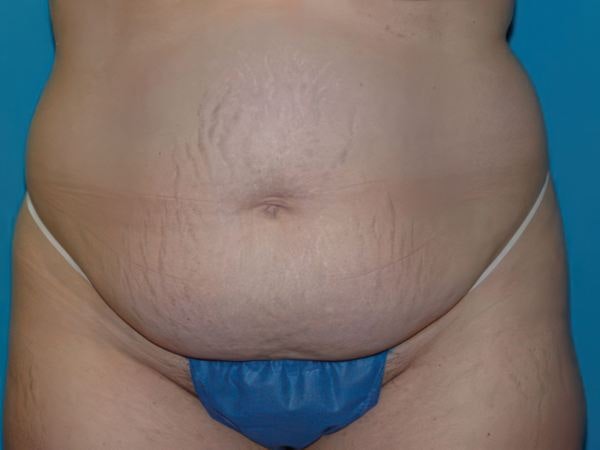 before tummy tuck