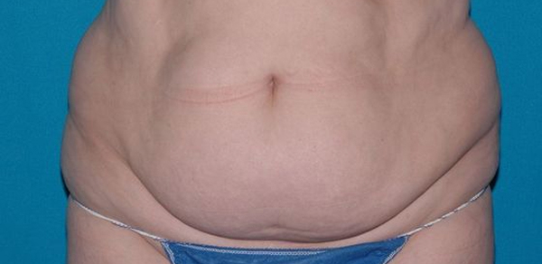 Carmel Cosmetic and Plastic Surgeons patient before tummy tuck