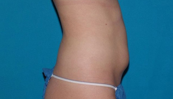 Carmel Cosmetic and Plastic Surgeons patient before liposuction