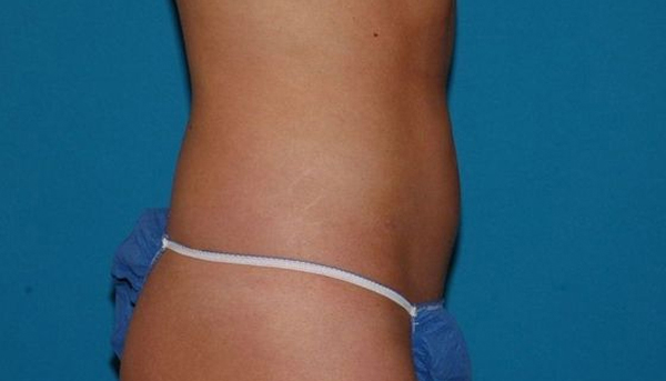 Carmel Cosmetic and Plastic Surgeons patient after liposuction
