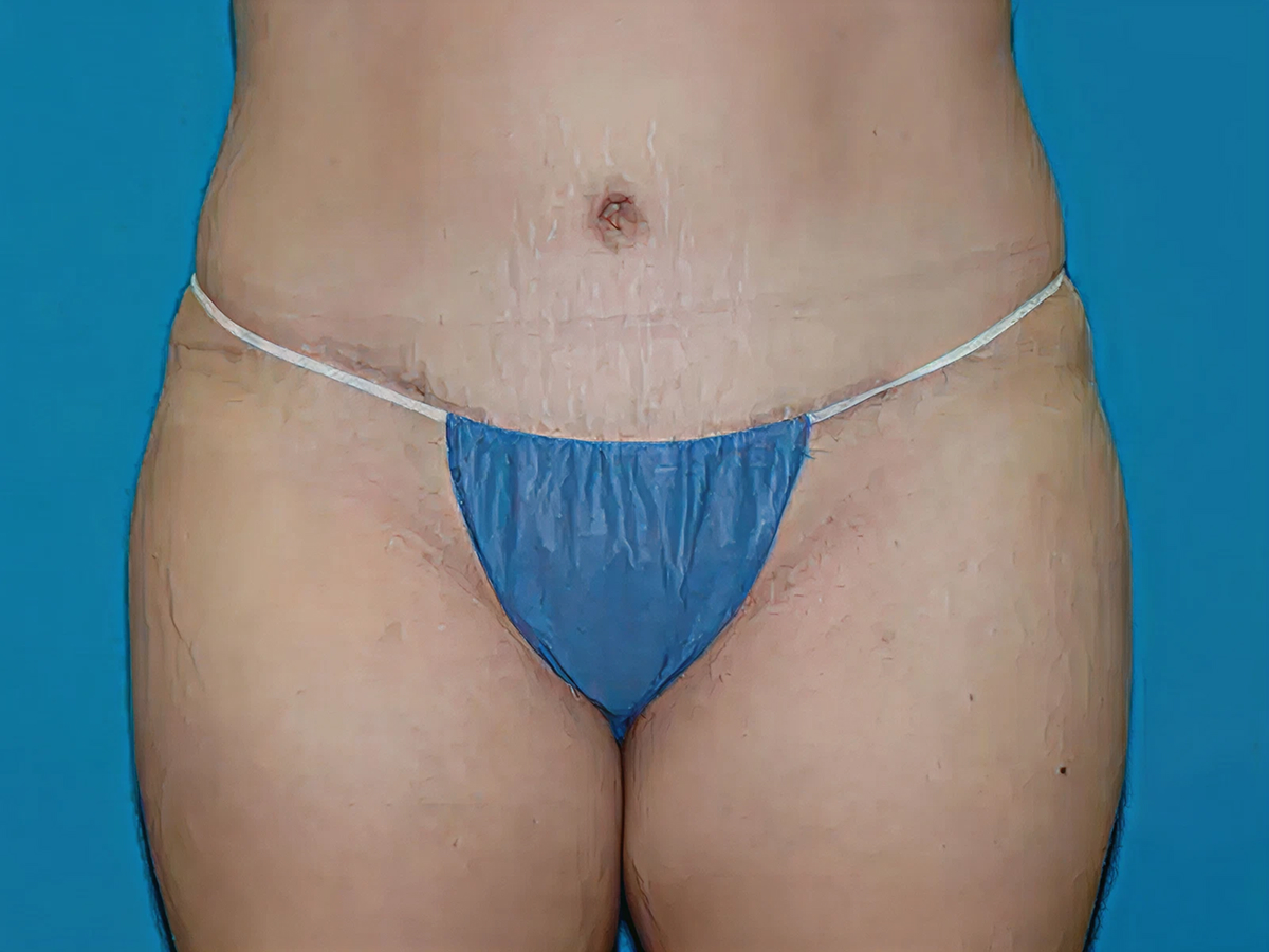 Indianapolis patient after tummy tuck