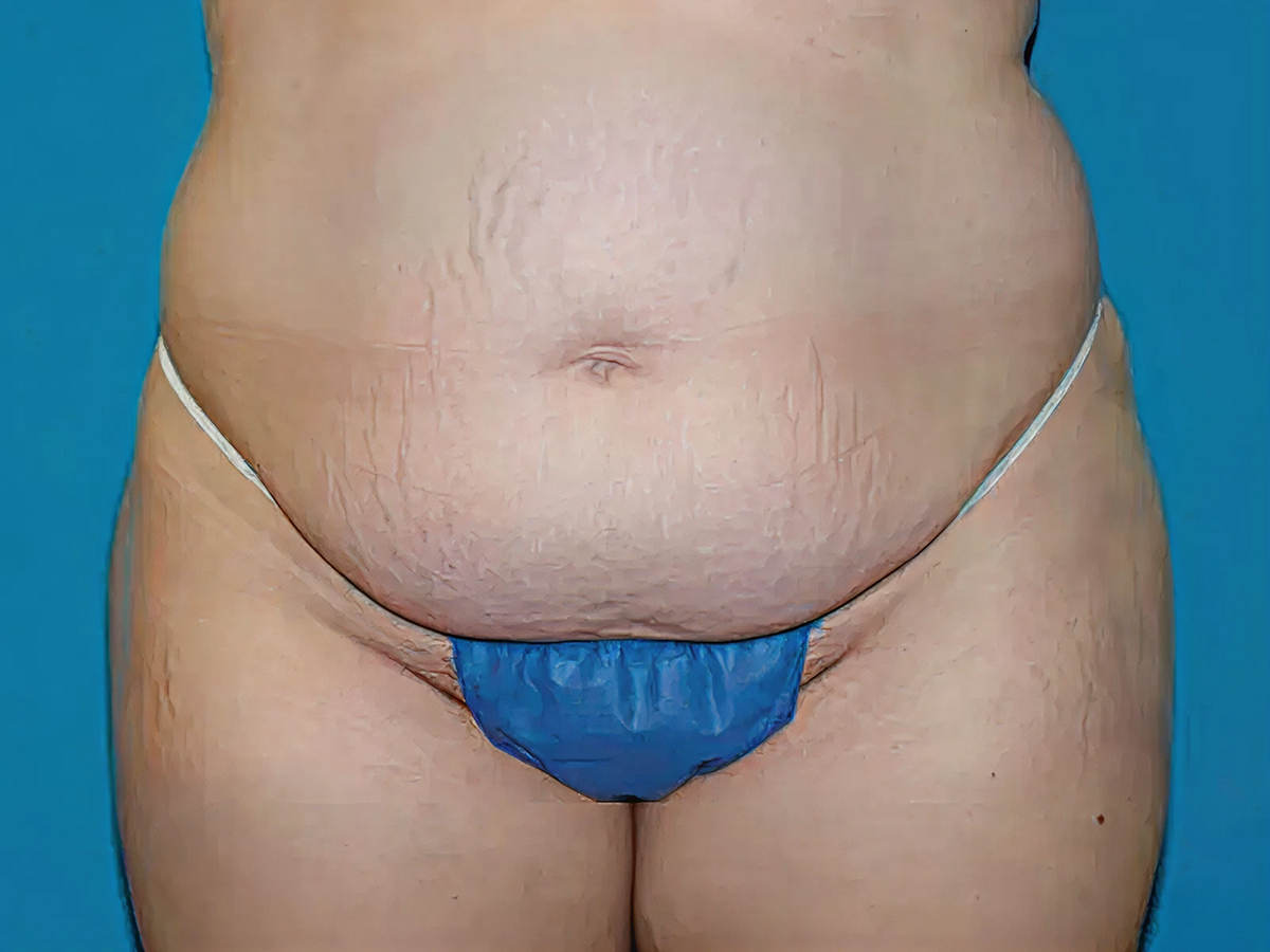 Indianapolis patient before tummy tuck