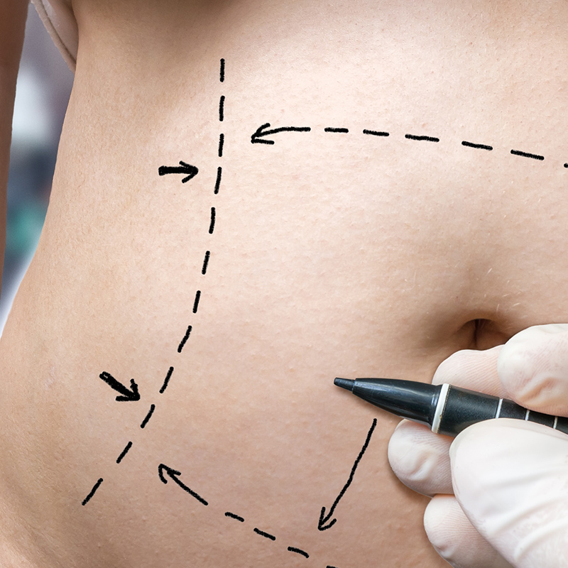 mapping out a tummy tuck