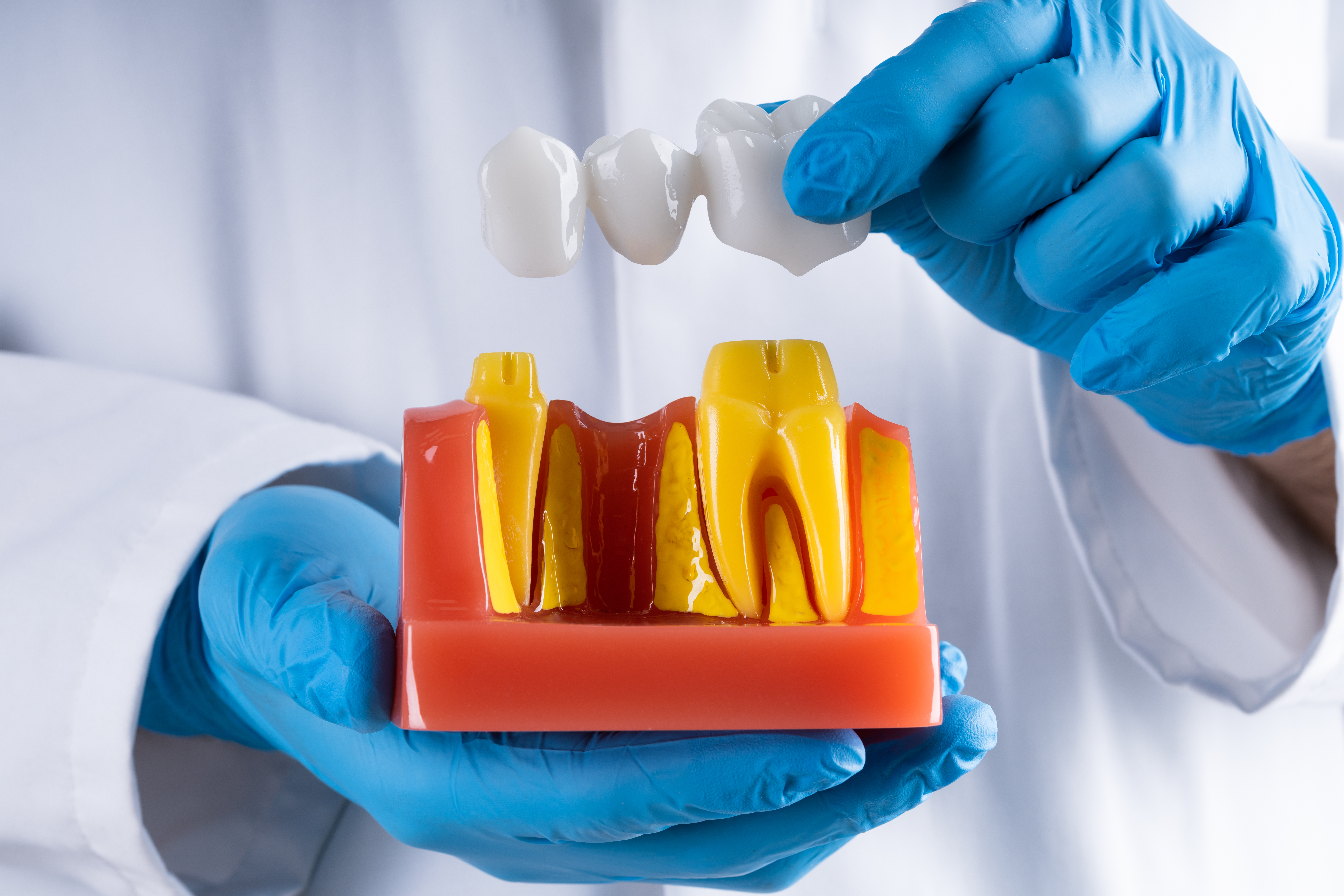 Dental bridge model