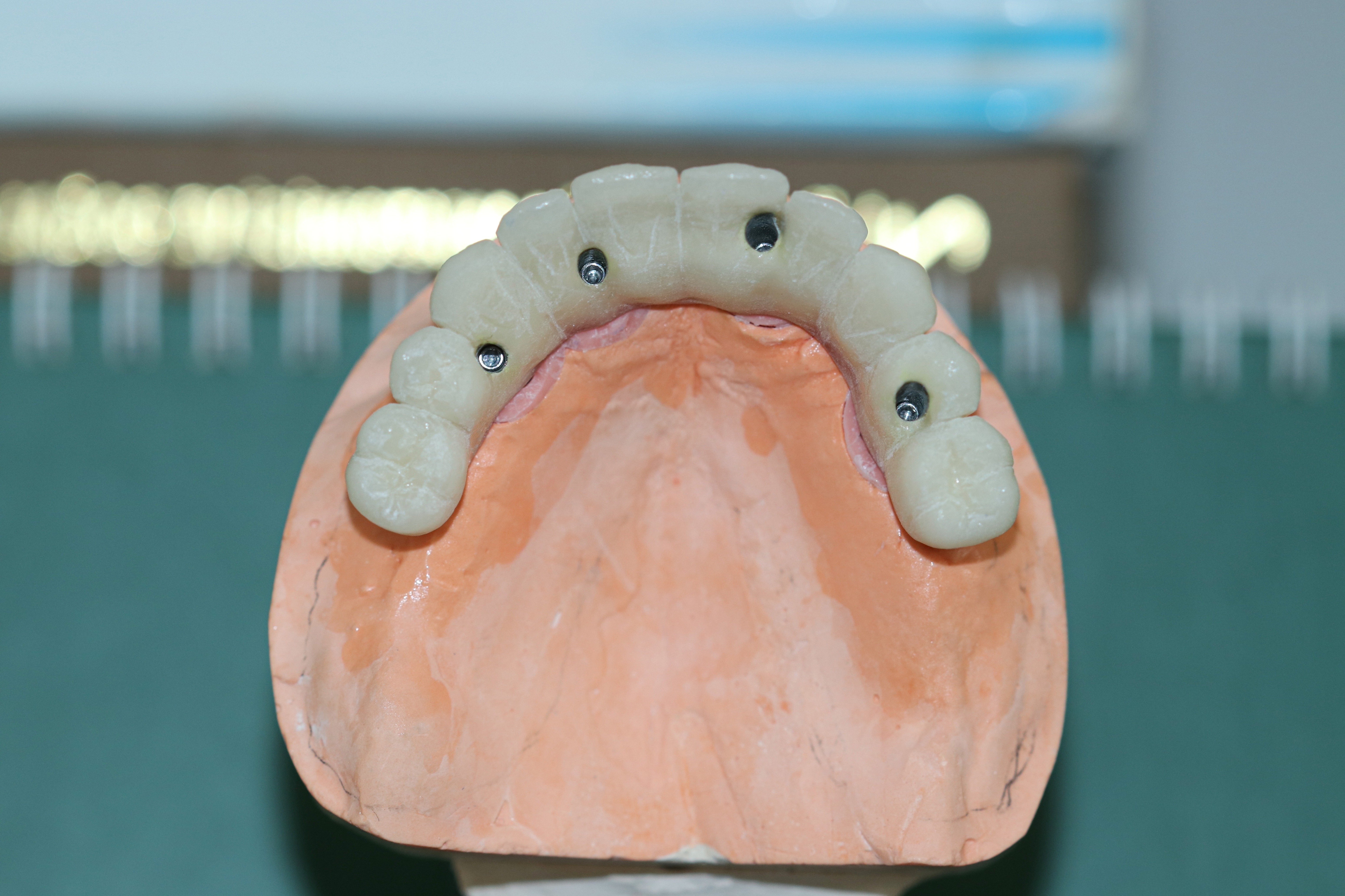 all-on-4 dental implant model