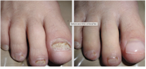 ten days after nail thinning, the nail showed signs of improvement. |  Download Scientific Diagram