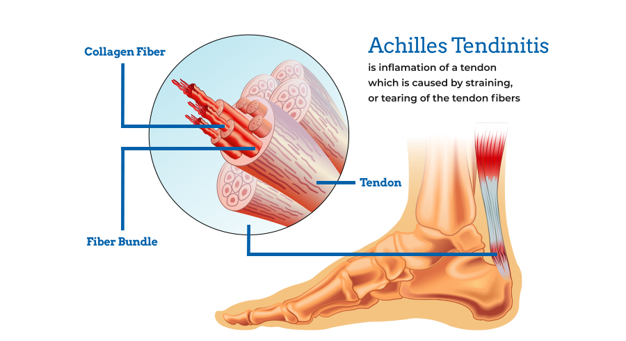 Achilles tendinitis diagram