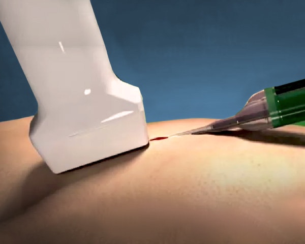 Tenex needle during procedure