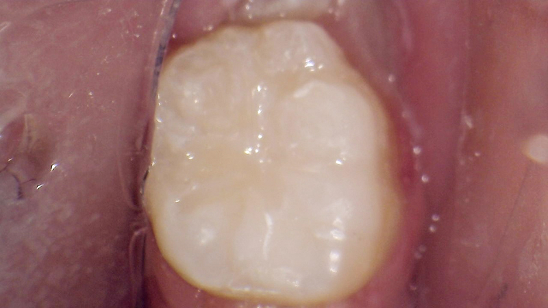 White filling
