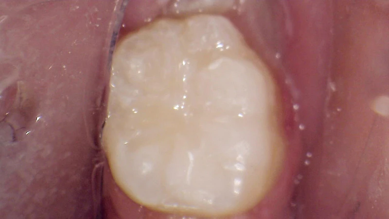 White filling