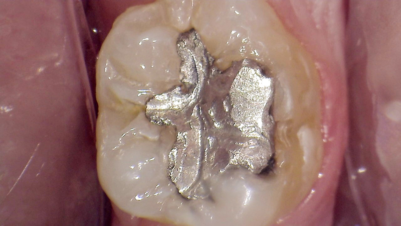 Silver filling