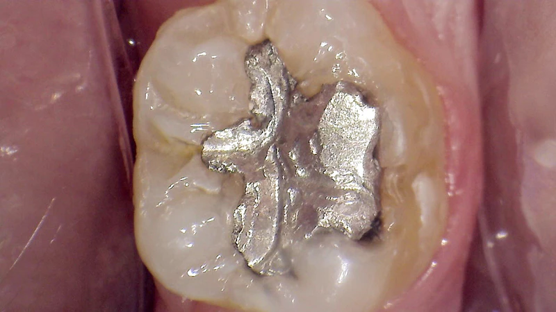 Silver filling