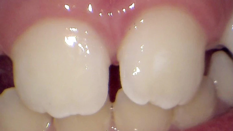 Before and After images of discoloration treatment from Children