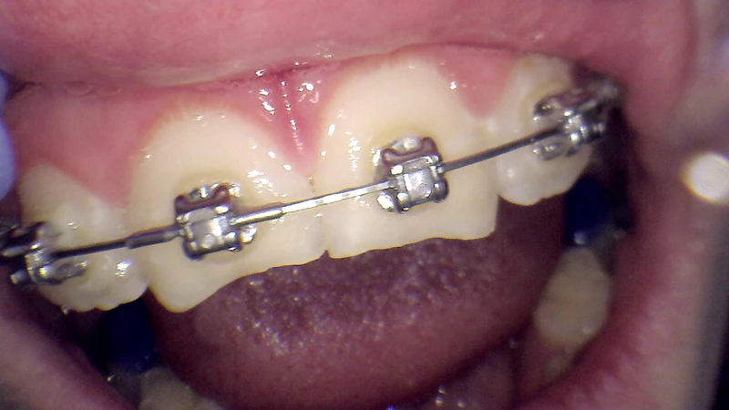 Before and After Dental Bonding from Children