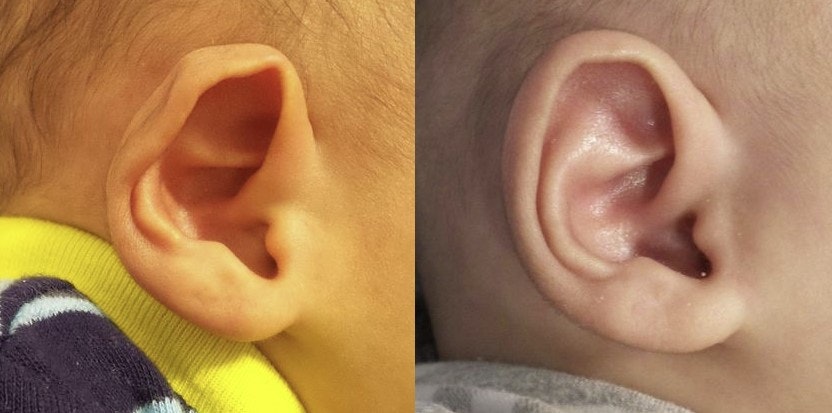 Before and after of ear molding with a custom prosthesis