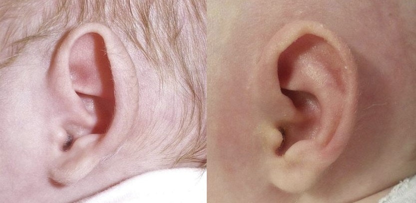 Before and after of ear molding with a custom prosthesis