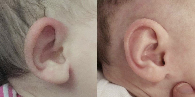 Before and after of ear molding with a custom prosthesis