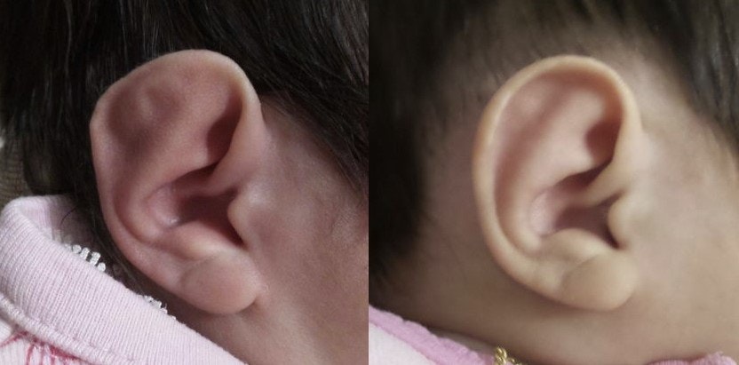 Stahl's ear deformity before and after treatment