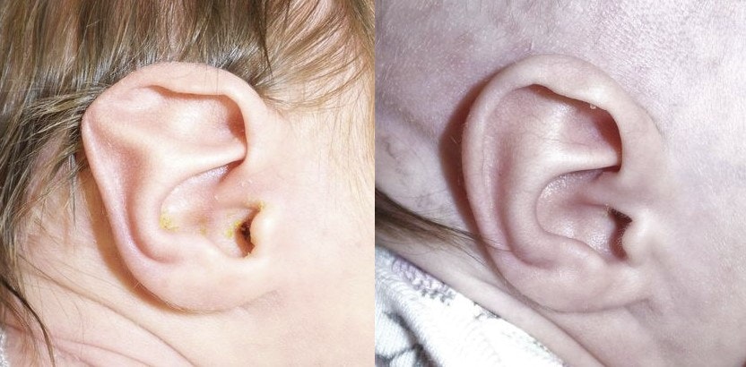 Stahl's ear deformity before and after treatment