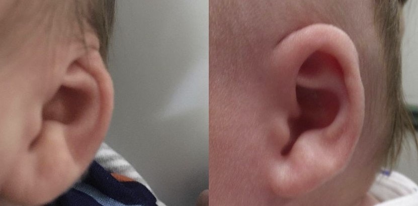 Cryptotia Ear Deformity before and after Ear Molding
