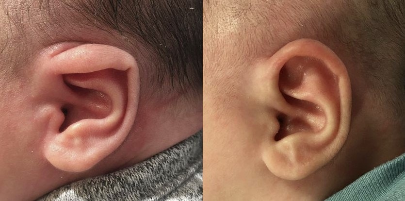 Before and after ear lidding treatment