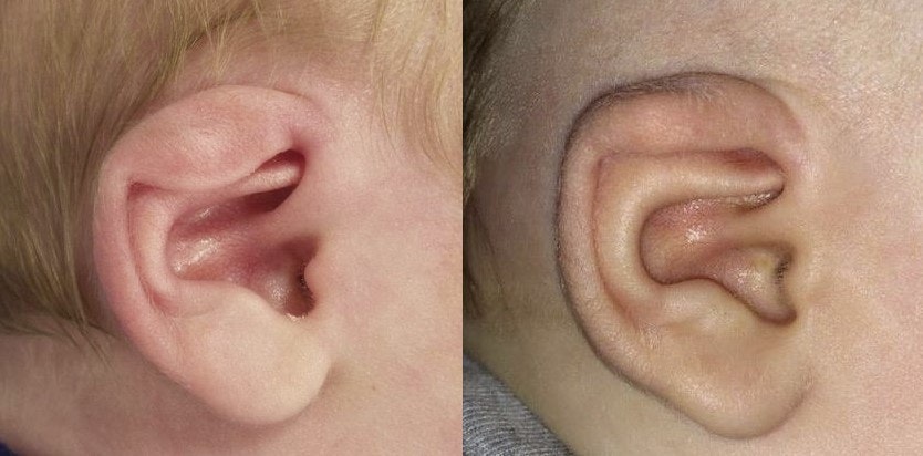 Before and after ear lidding treatment